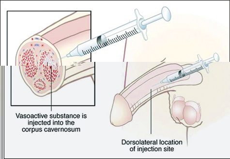 ic-injection.jpg